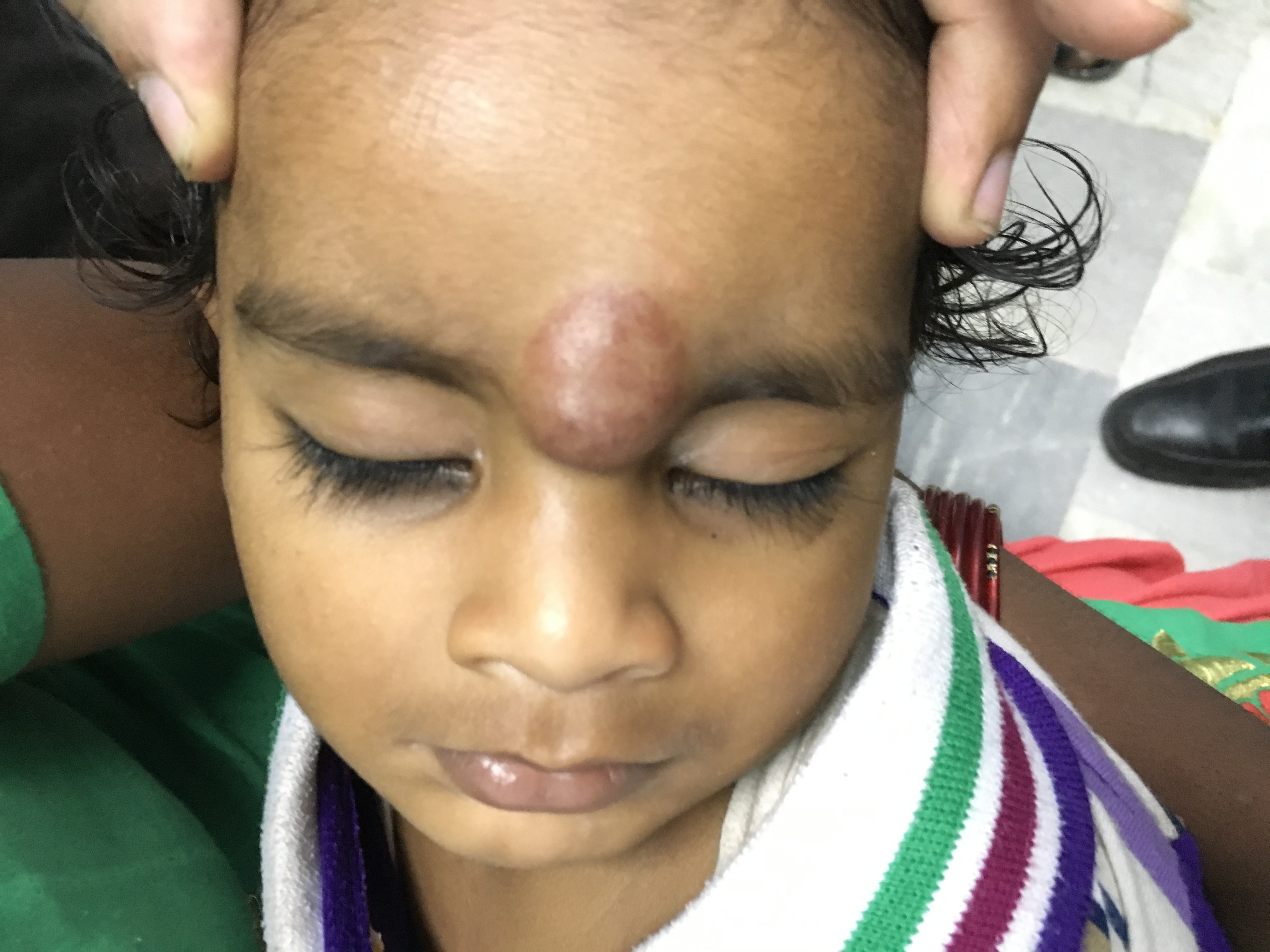 Pediatric Plastic Surgery Image 8
